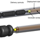 A diagram of the occluder deployment system.